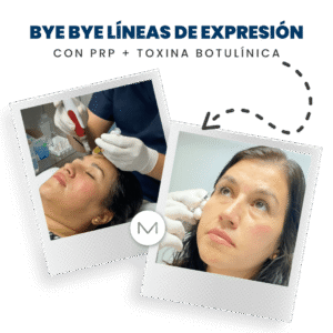 BYE BYE LÍNEAS DE EXPRESIÓN