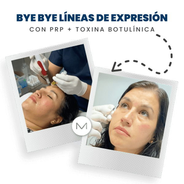 BYE BYE LÍNEAS DE EXPRESIÓN